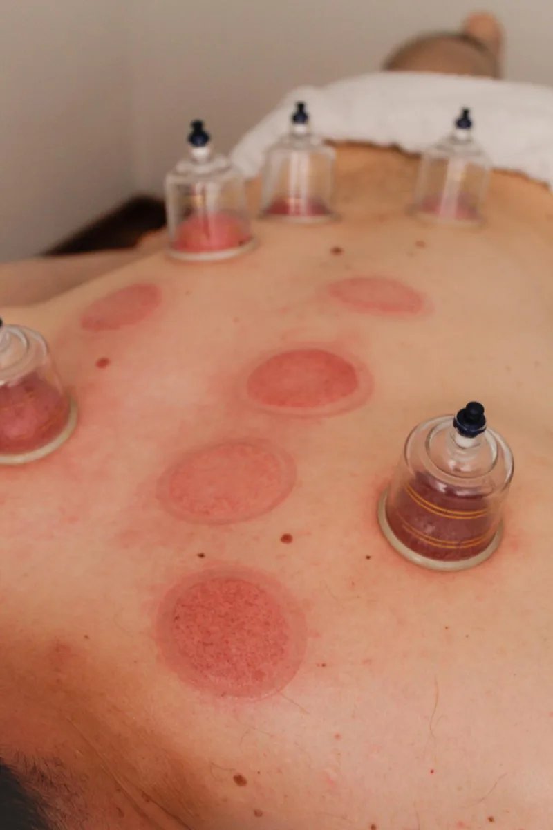 Cupping terapija